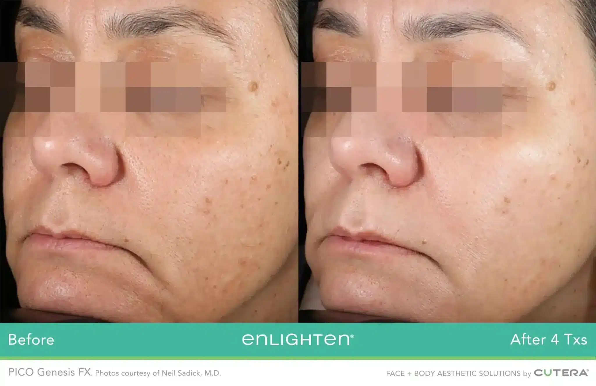 Facial pigmentation and complexion before and after four PICO Genesis FX treatments