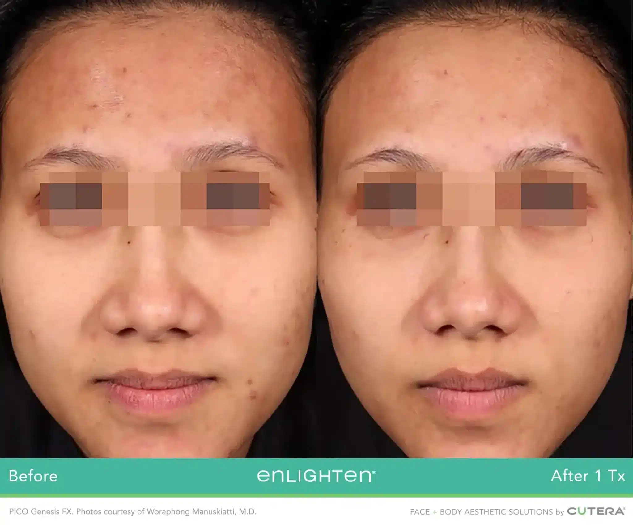 Front-view comparison showing improved facial skin tone after one PICO Genesis FX treatment