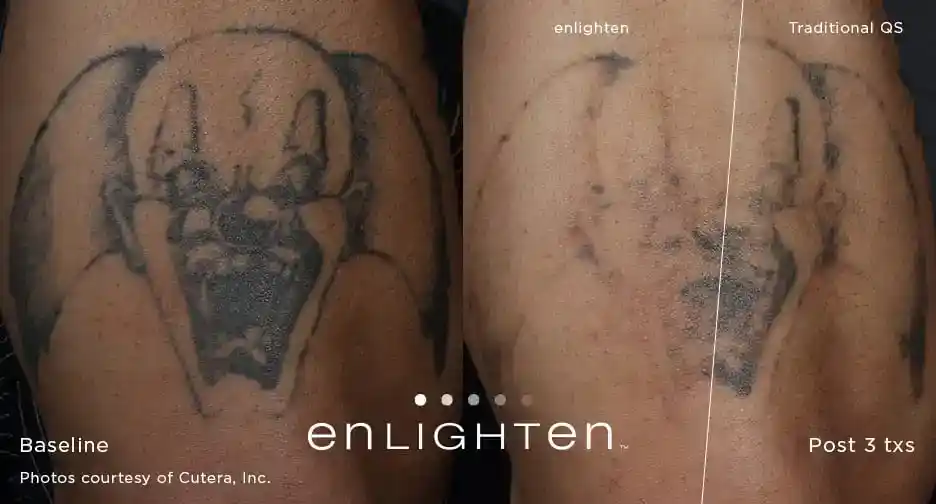 Clown tattoo removal comparison between Enlighten III and traditional Q-switched laser