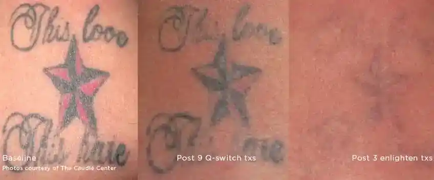 Coloured star tattoo results after nine Q-switched treatments and three Enlighten treatments