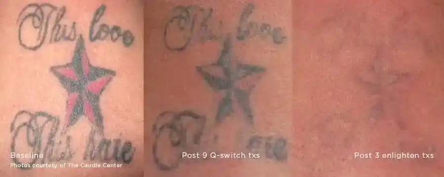Star and lettering tattoo removal comparison after Q-switched and Enlighten III treatments