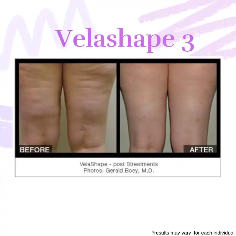 VelaShape III front-thigh cellulite reduction before and after three treatments