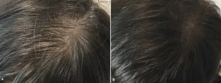 Male scalp hair density before and after Arthrex ACP PRF hair loss treatment