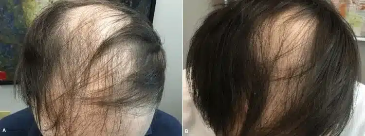 Male crown hair thinning before and after Arthrex ACP PRF hair restoration treatment
