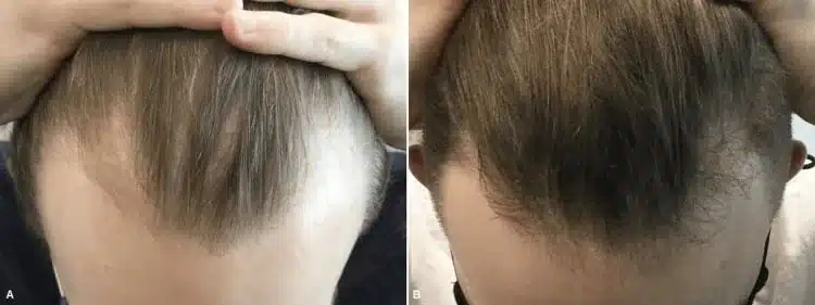 Male receding hairline before and after Arthrex ACP PRF hair restoration treatment