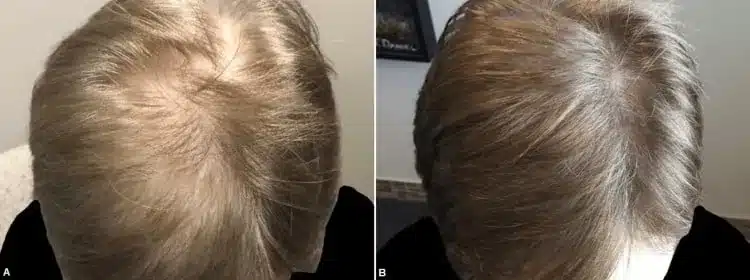 Male thinning crown before and after Arthrex ACP PRF treatment for hair loss