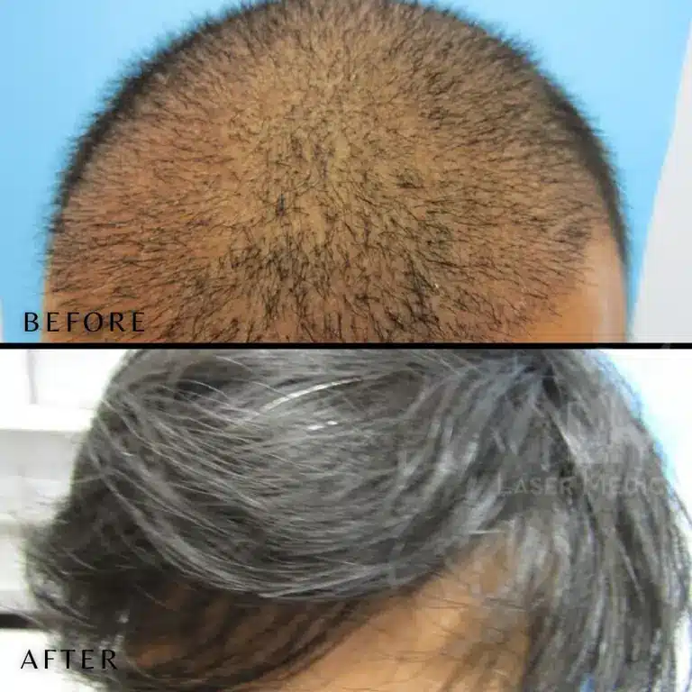 Before and after PRP hair treatment used to support hair transplant results