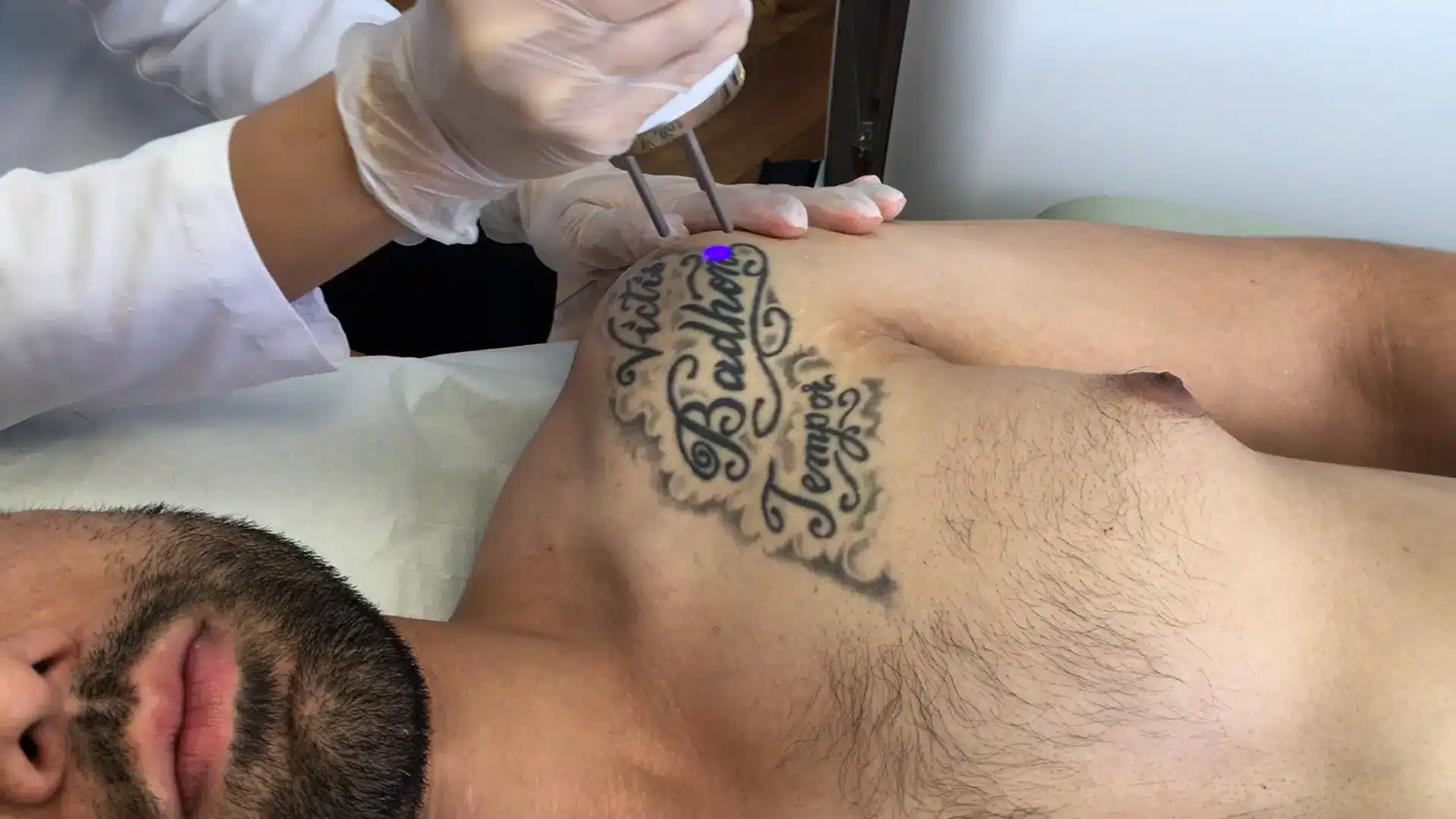 Cutera Enlighten III laser tattoo removal treatment