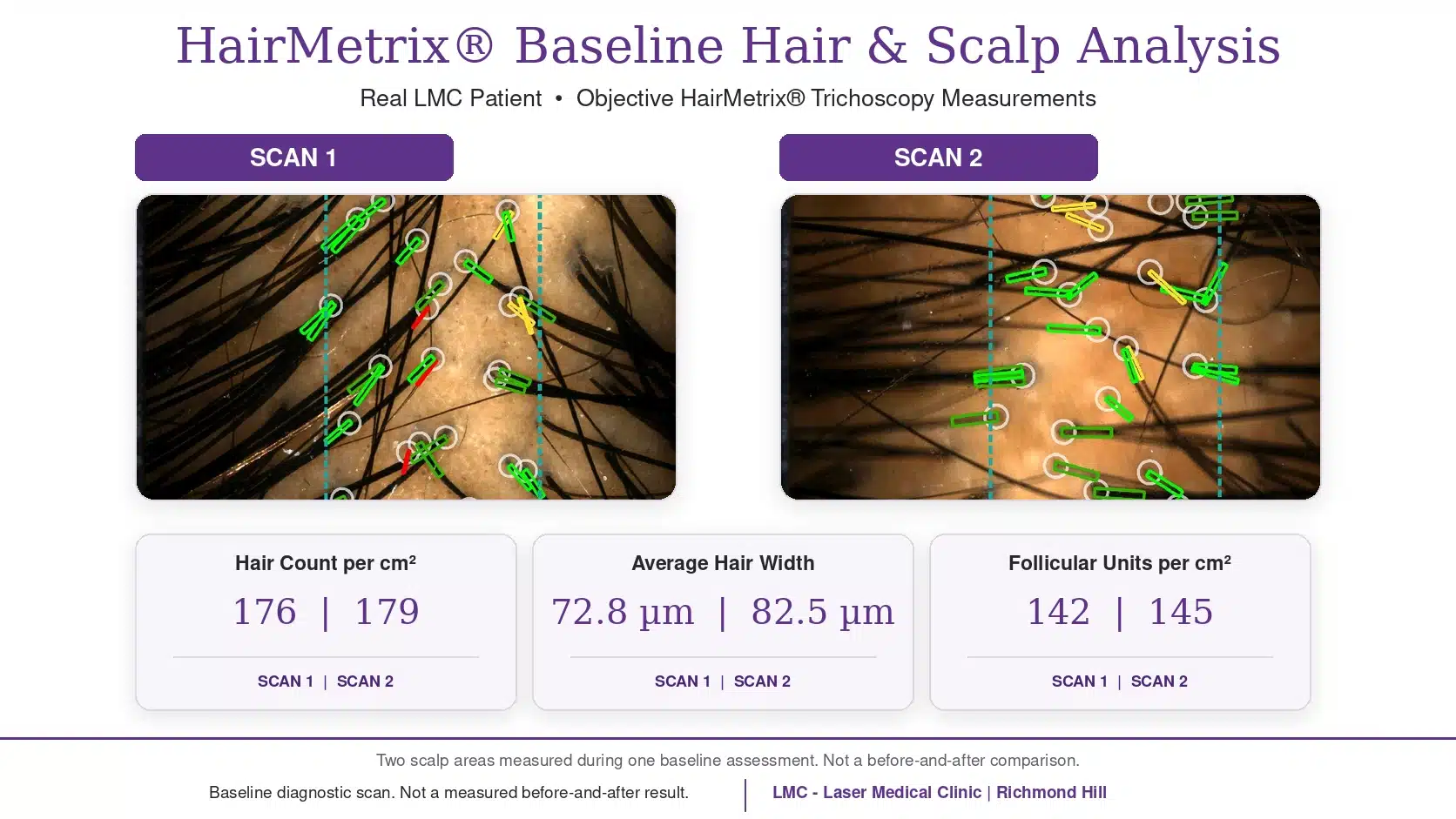 Male Hair Restoration Case Study | PRP + MCT Results