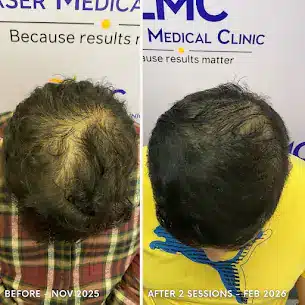 Male PRP hair restoration result after two sessions