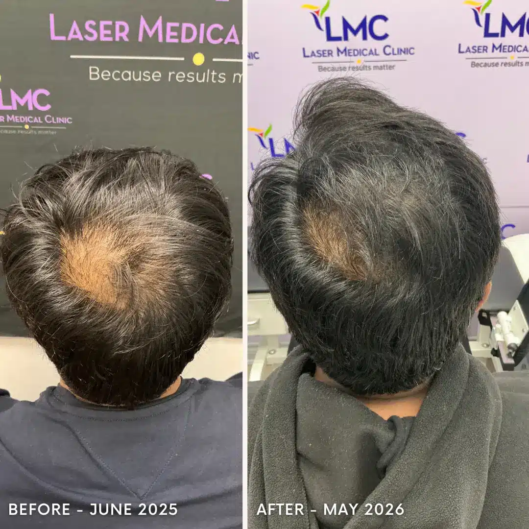 Anonymous male regenerative hair restoration before-and-after comparison of the crown