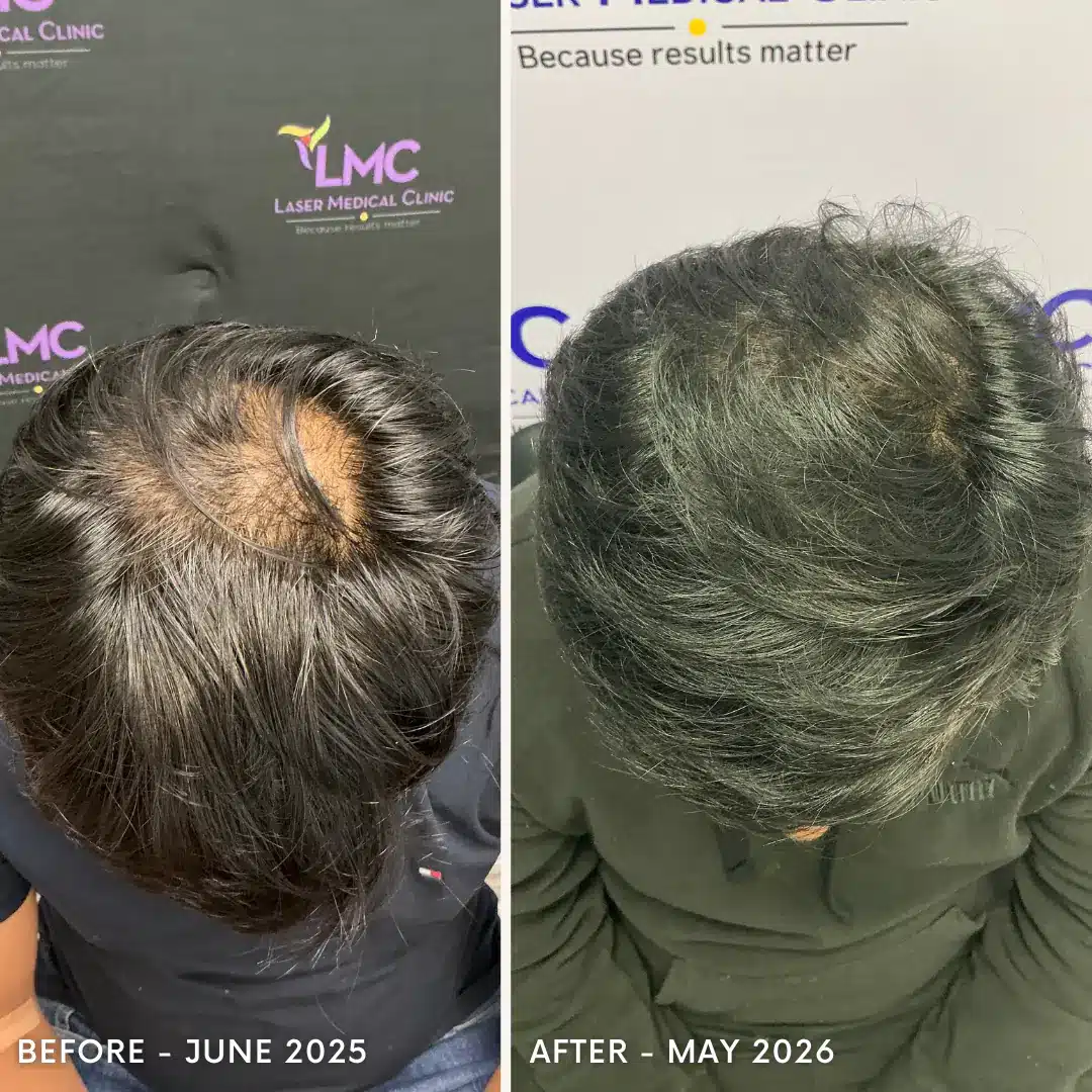 Anonymous male regenerative hair restoration before-and-after comparison from the top view