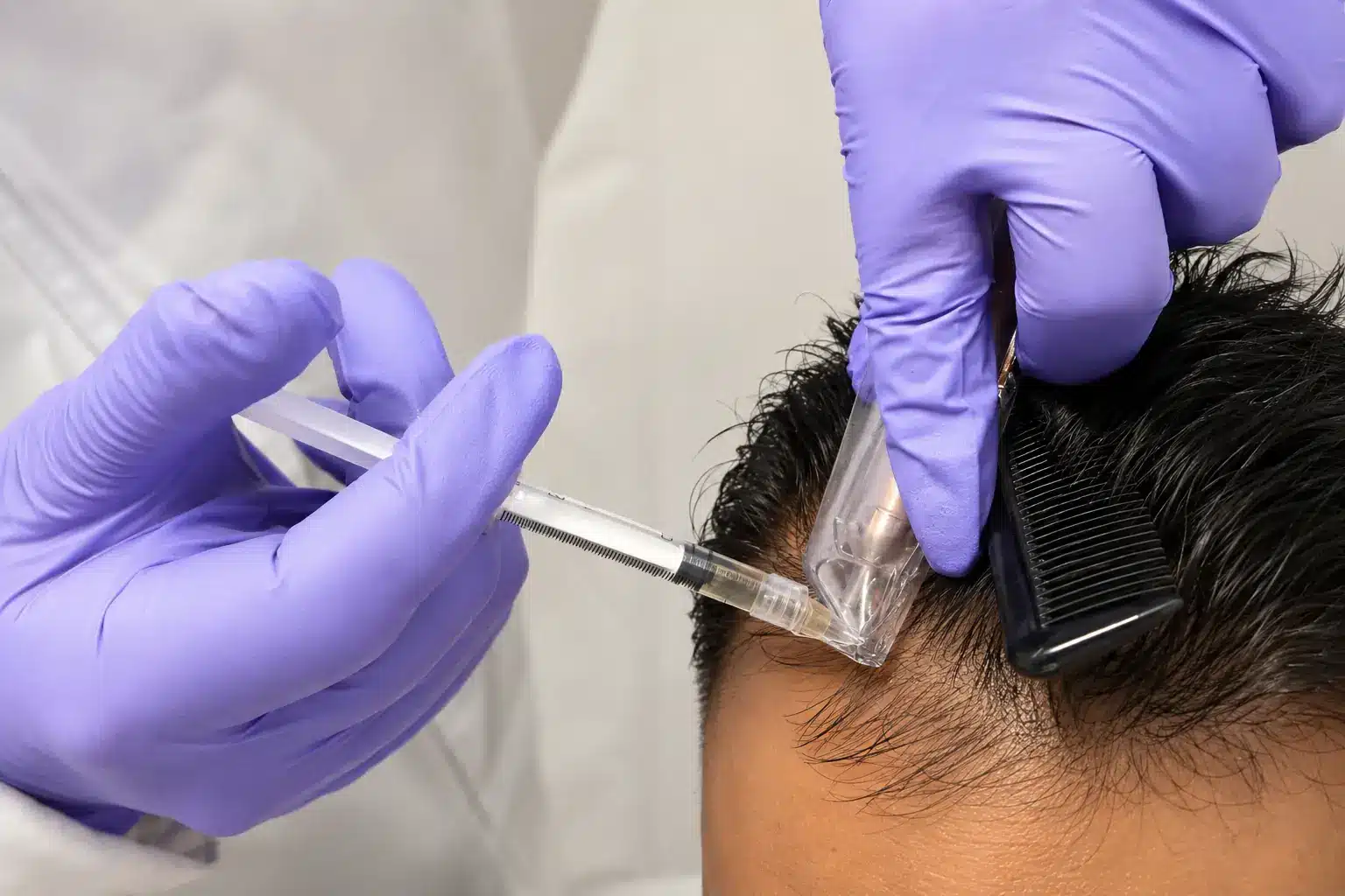 PRF Hair Treatment with Arthrex ACP
