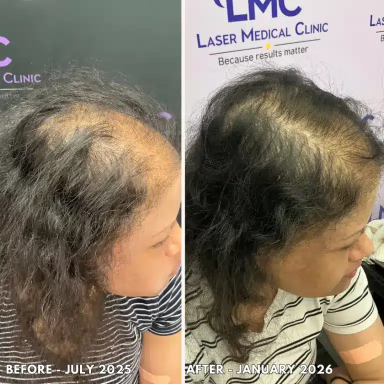 Before and after PRP hair treatment for female pattern hair thinning and widening part line