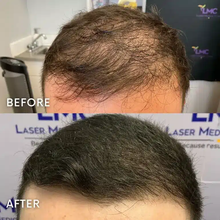 Before and after PRP hair treatment for male pattern hair loss and receding hairline