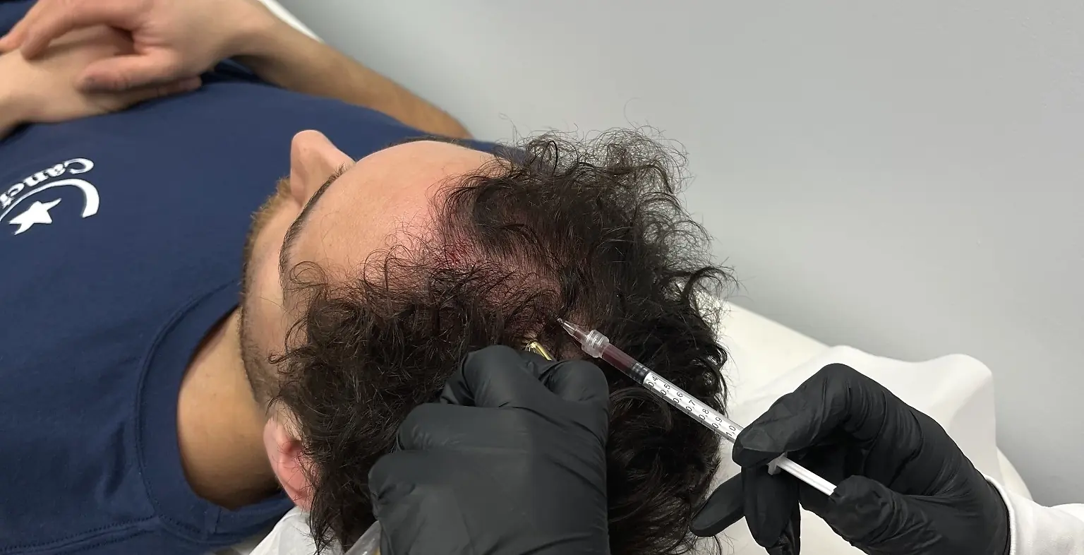 PRP hair treatment before and after result from a patient treated at LMC
