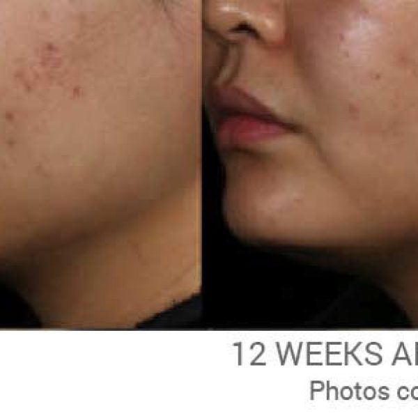 Pico Genesis Fx Treatment Before After 12 Weeks